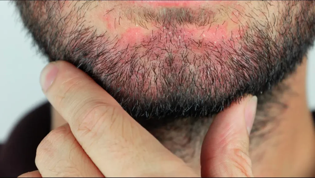 Skin Conditions and Scarring