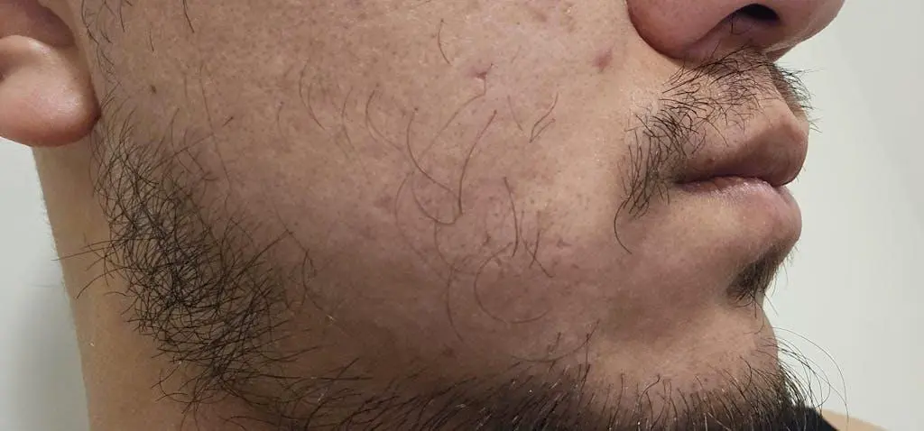 Patchy Growth