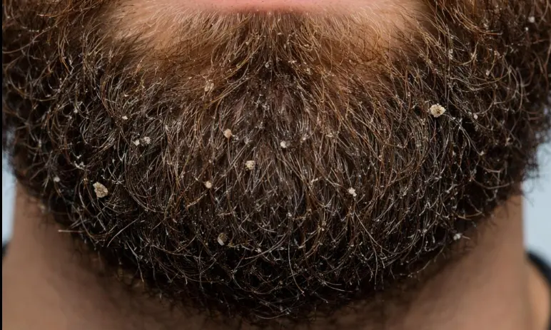 Dry Beard
