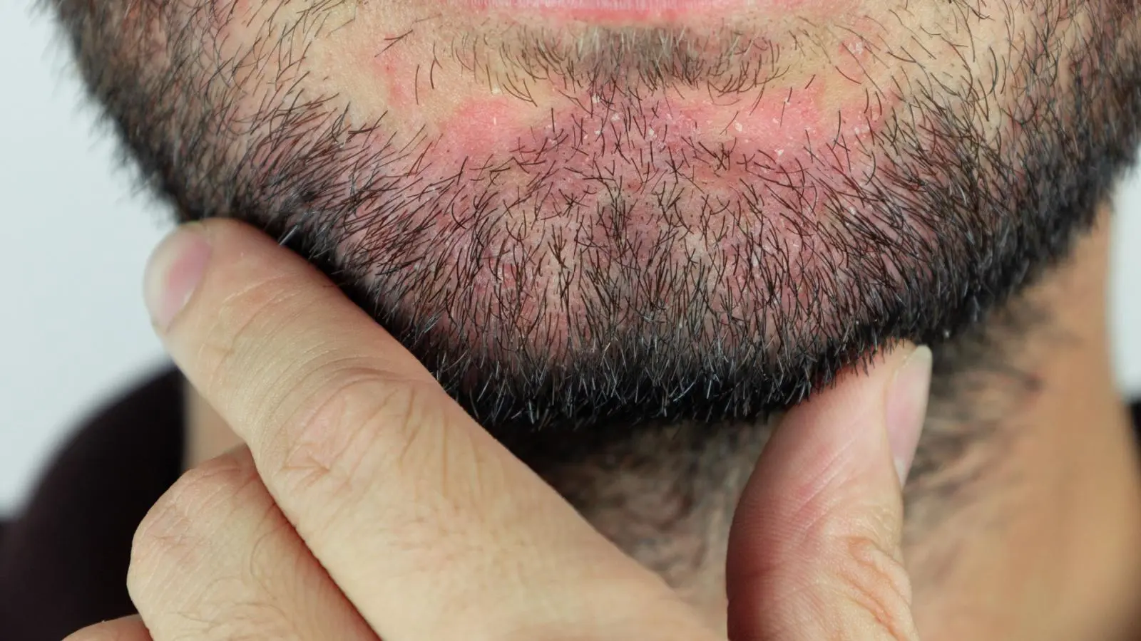 Beard Itching