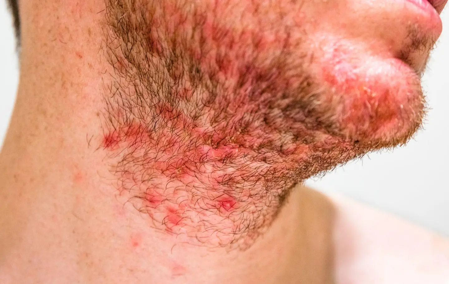 Ingrown Beard Hair