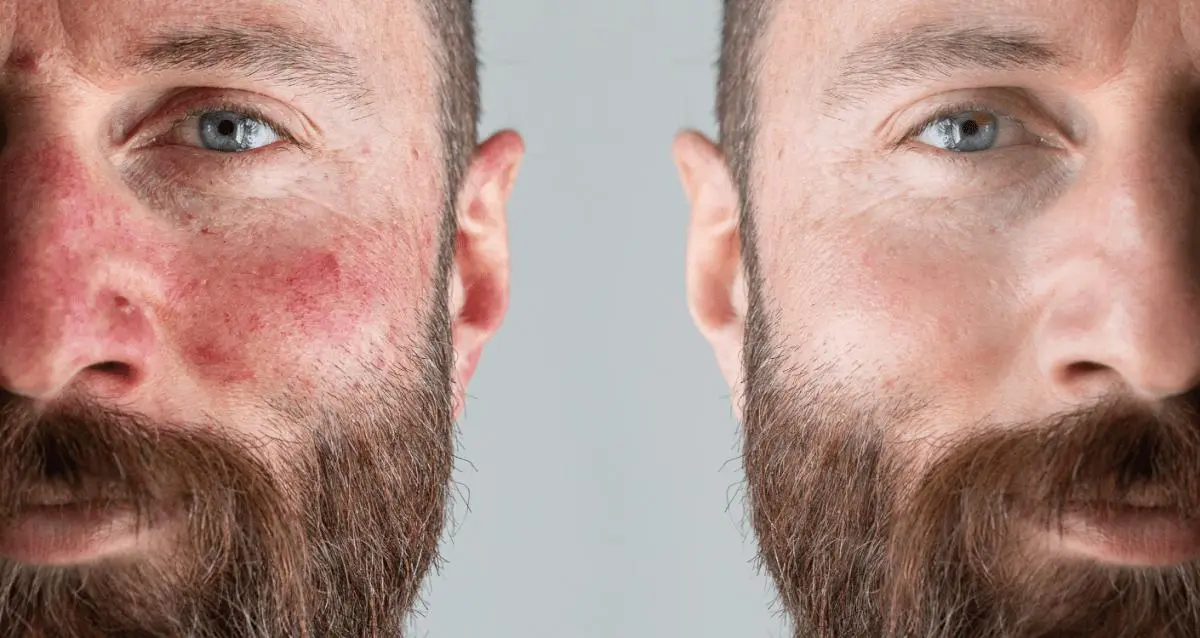 Beard Acne