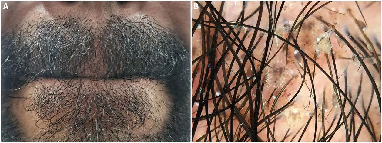 Beard Lice