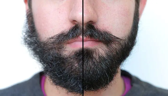 Beard Sun Damage